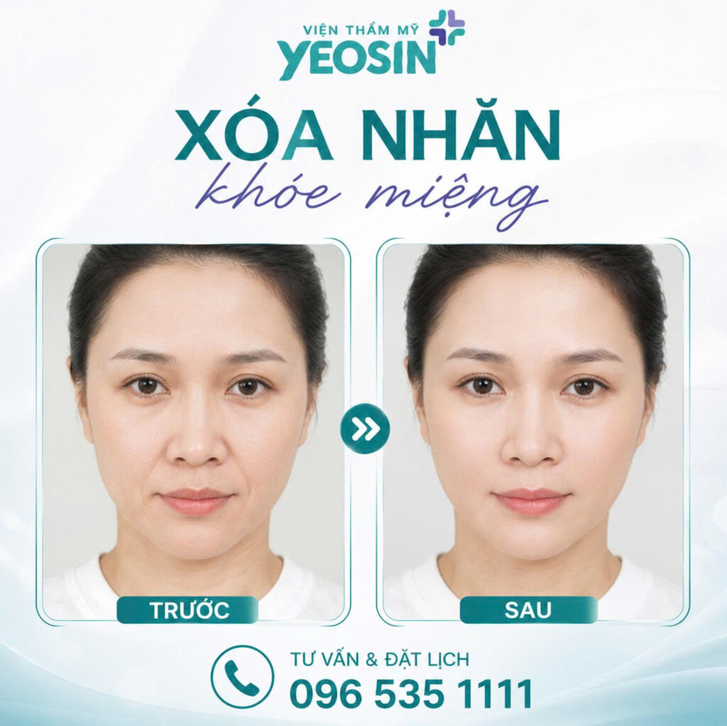 Hình ảnh trước và sau khi xóa nhăn khóe miệng tại Yeosin