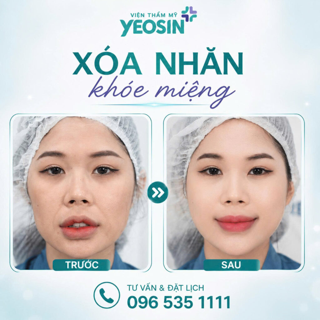Hình ảnh trước và sau khi xóa nhăn khóe miệng tại Yeosin