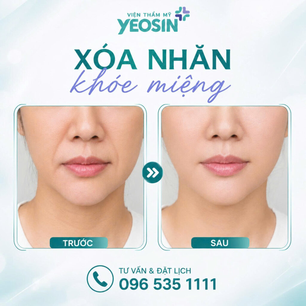 Hình ảnh trước và sau khi xóa nhăn khóe miệng tại Yeosin