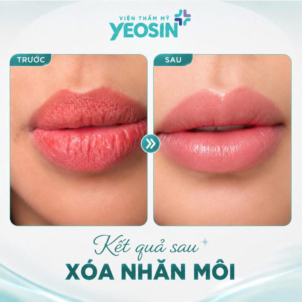Hình ảnh trước và sau khi xóa nhăn môi tại Yeosin