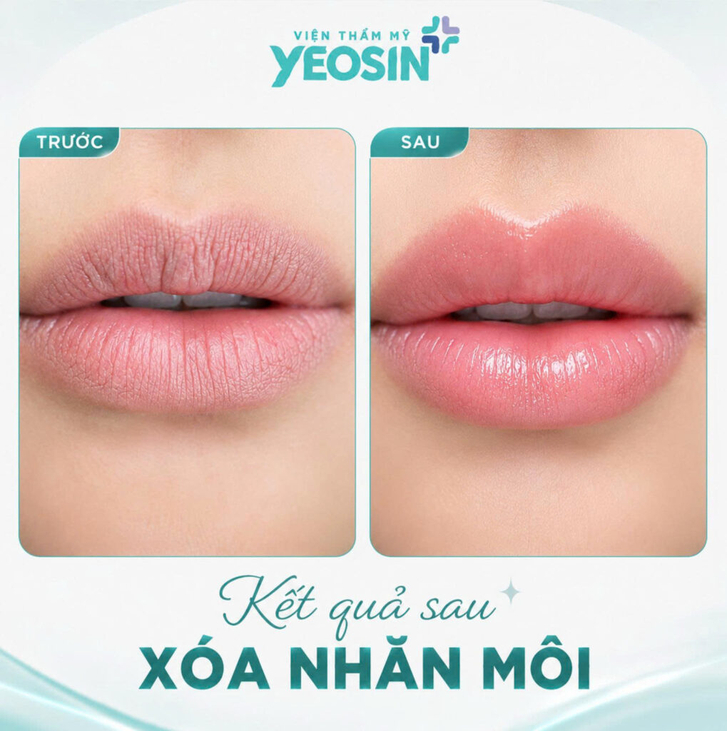Hình ảnh trước và sau khi xóa nhăn môi tại Yeosin