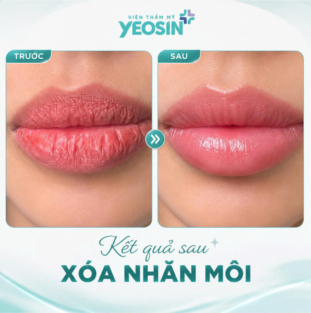 Hình ảnh trước và sau khi xóa nhăn môi tại Yeosin