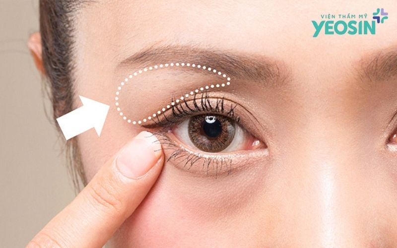 Đối tượng phù hợp lấy mỡ thừa mí mắt