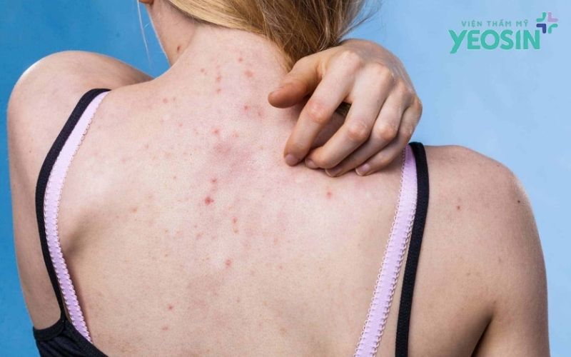 Những sai lầm cần tránh khi trị mụn lưng tuổi dậy thì