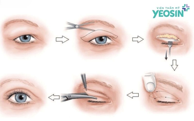 Lấy mỡ thừa kết hợp cắt da dư