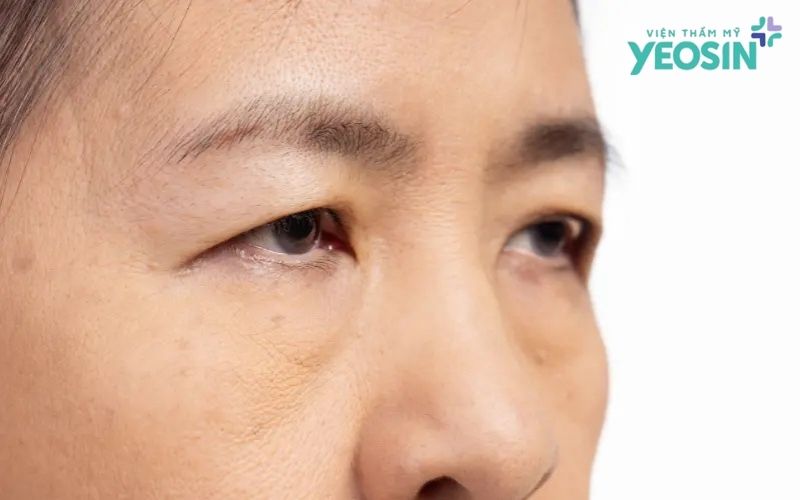 Nguyên nhân gây mỡ thừa mí mắt