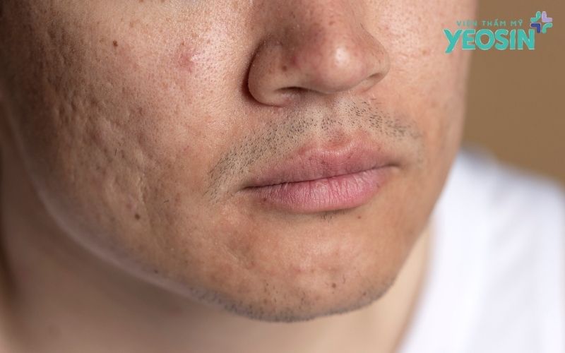 Sẹo Rỗ Có Chữa Được Không?