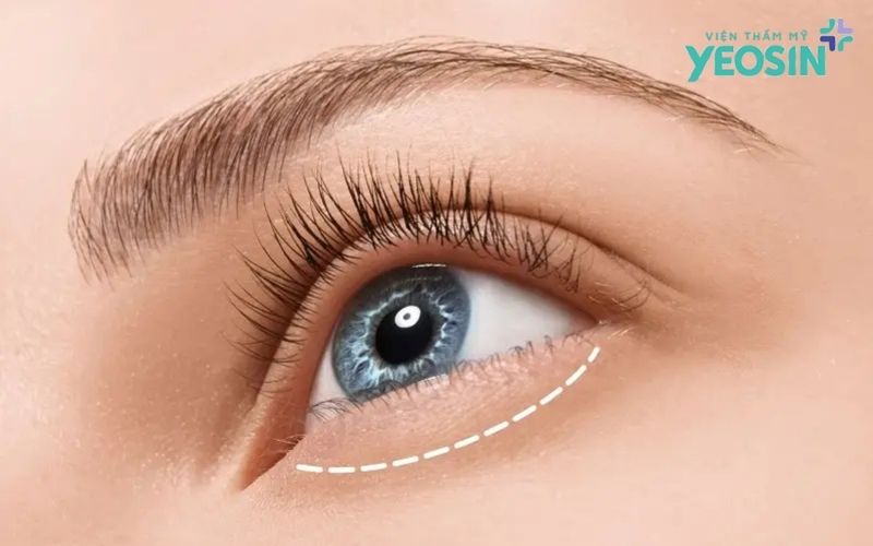 Các công nghệ hỗ trợ trẻ hóa vùng mắt