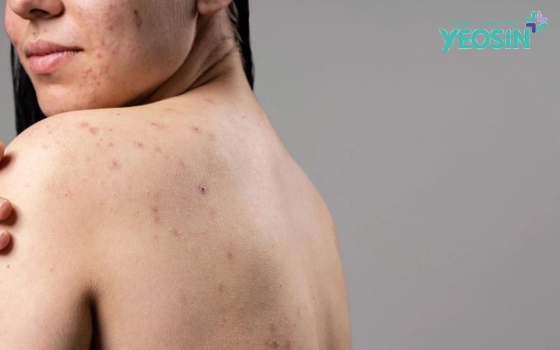Mụn lưng ở tuổi dậy thì là gì?