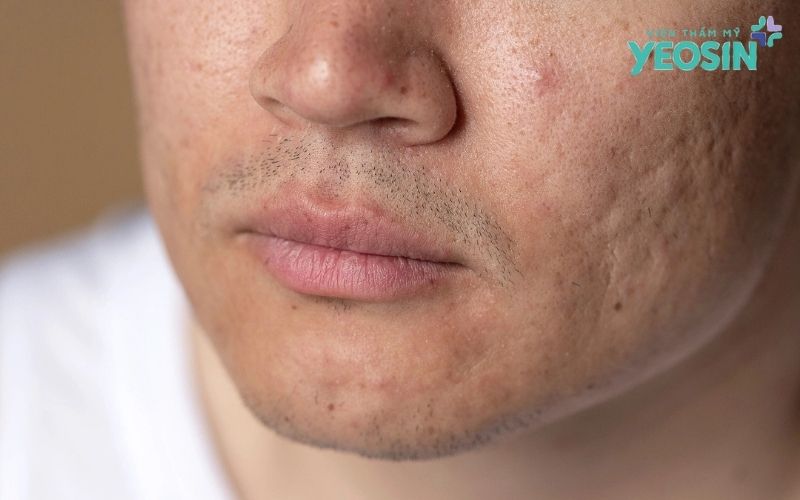 Nam giới có cần skincare không? Quy trình chăm sóc da tối giản 10 Những sai lầm phổ biến nam giới cần tránh