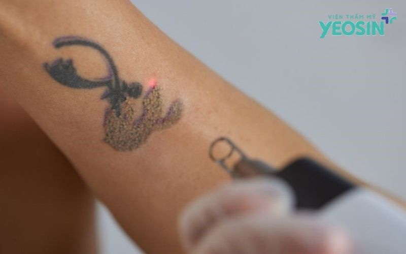 Khi nào nên lựa chọn xóa xăm bằng công nghệ?