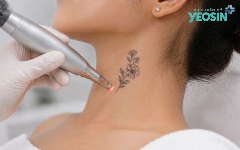 Xóa xăm bằng công nghệ Laser Picosure