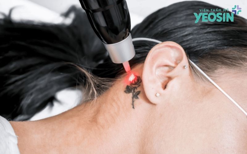 Quy trình xóa xăm bằng công nghệ Laser Picosure tại Yeosin