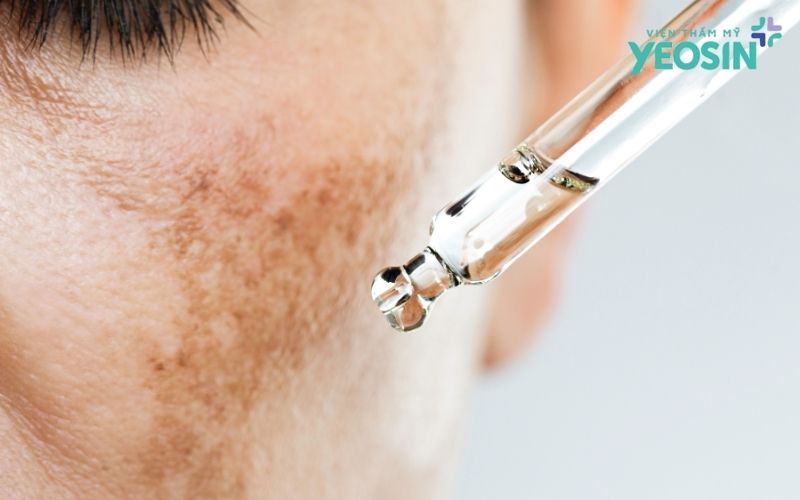 Các phương pháp điều trị nám da