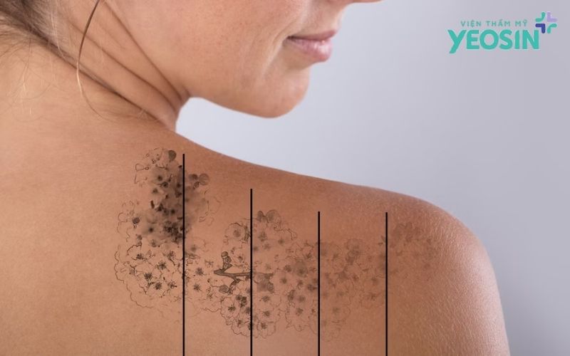 Xóa xăm bằng công nghệ có ưu điểm gì?