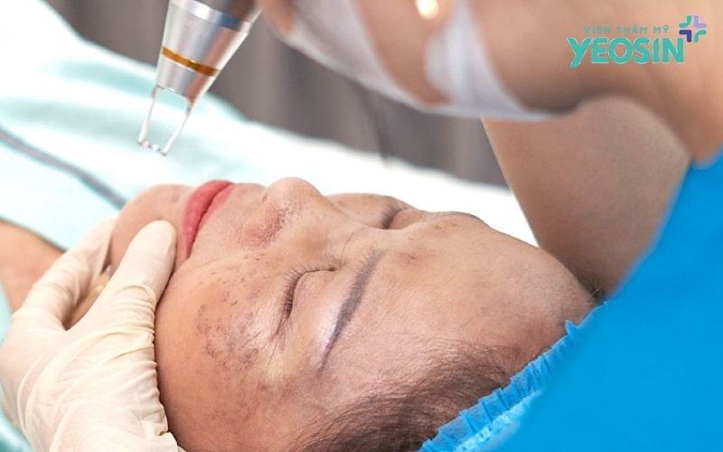 Điều trị nám da tại Yeosin