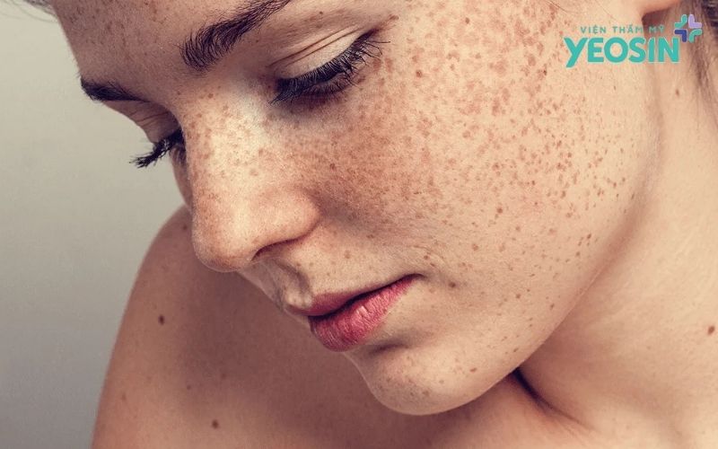 Những lưu ý quan trọng khi điều trị nám