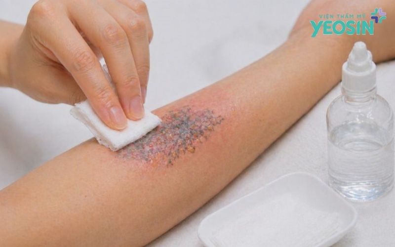 Chăm sóc da sau khi xóa xăm cần lưu ý gì?