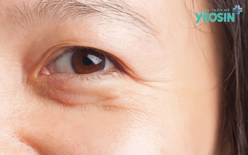 Mỡ thừa mí mắt là gì?