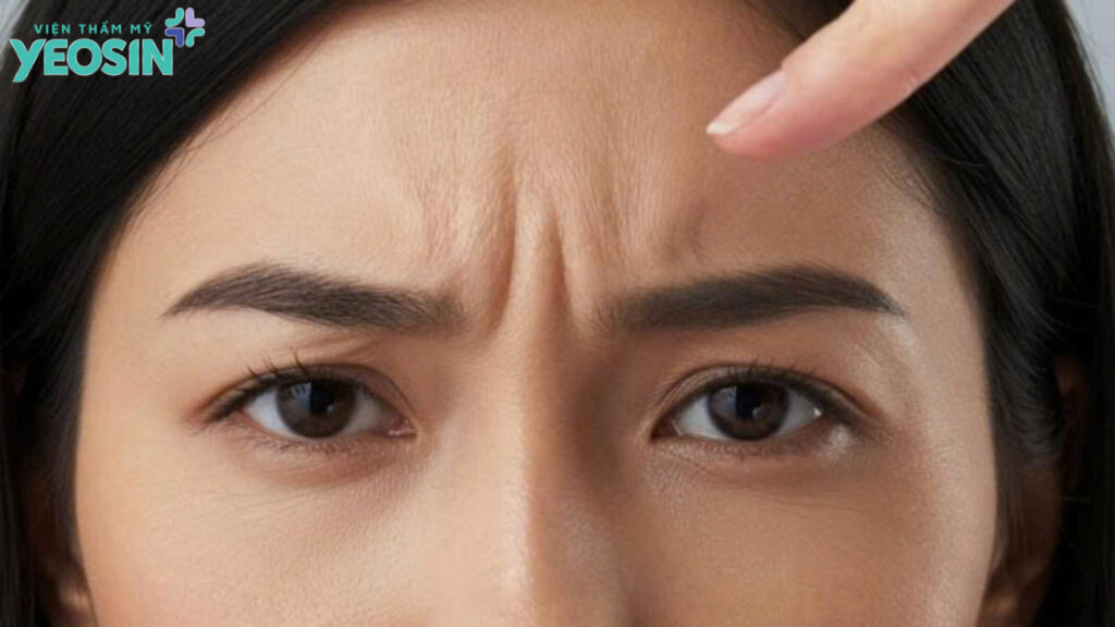 Tổng hợp 6 cách xóa nếp nhăn cau mày hiệu quả 15 Nếp nhăn cau mày là gì?