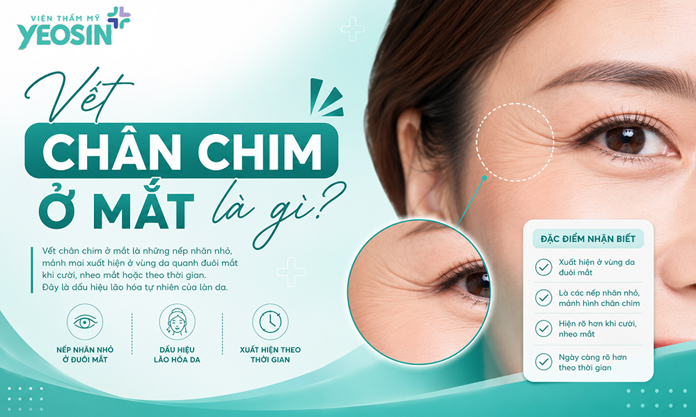 Vết chân chim ở mắt là gì?