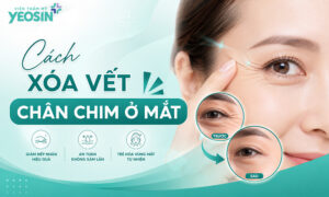 Vết chân chim ở mắt là gì?