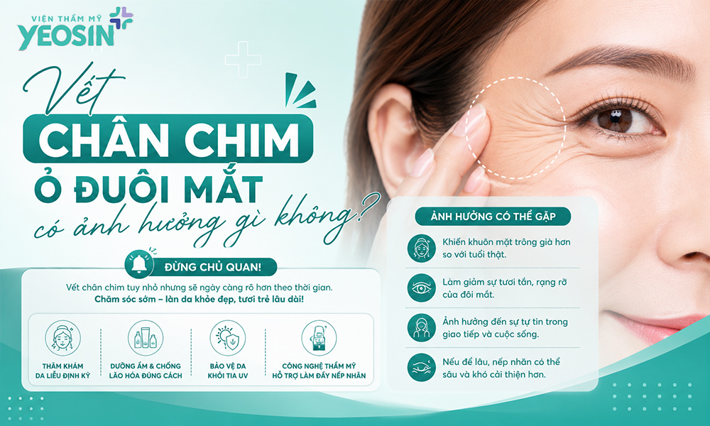 Vết chân chim ở đuôi mắt có ảnh hưởng gì không?