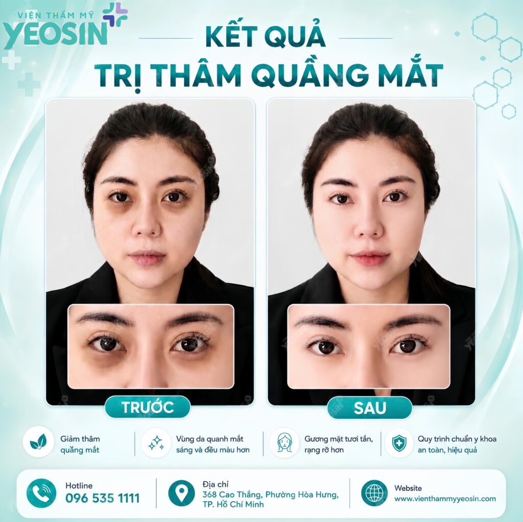 Hình ảnh trước và sau khi tiêm trị thâm quầng mắt tại Yeosin