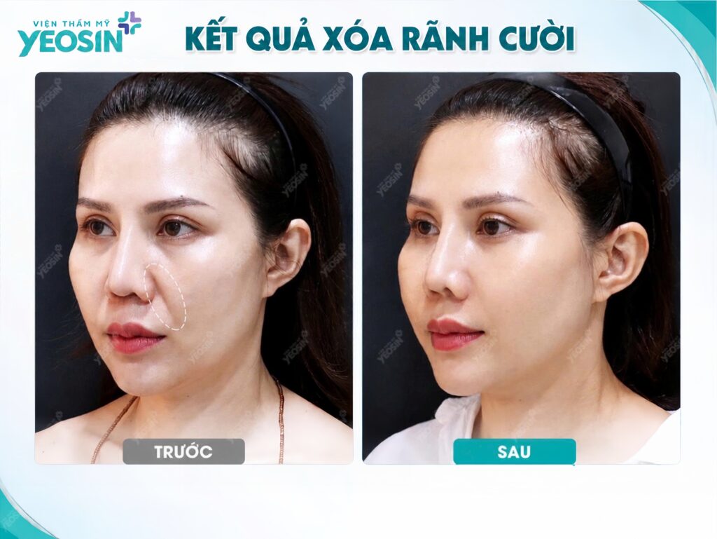 Hình ảnh trước và sau khi xóa rãnh cười tại Viện Thẩm Mỹ Yeosin