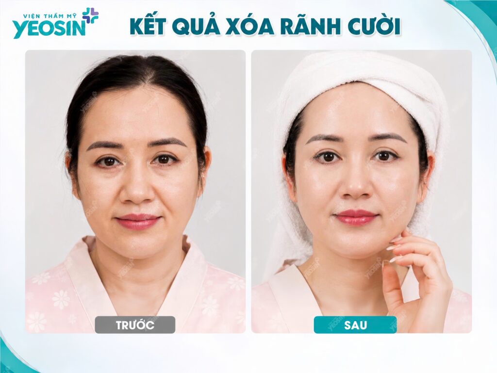 Hình ảnh trước và sau khi xóa rãnh cười tại Viện Thẩm Mỹ Yeosin