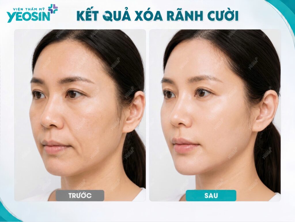 Hình ảnh trước và sau khi xóa rãnh cười tại Viện Thẩm Mỹ Yeosin
