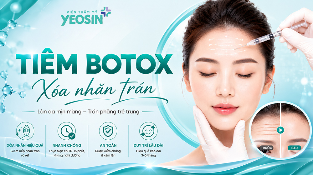 Tiêm botox xóa nhăn trán