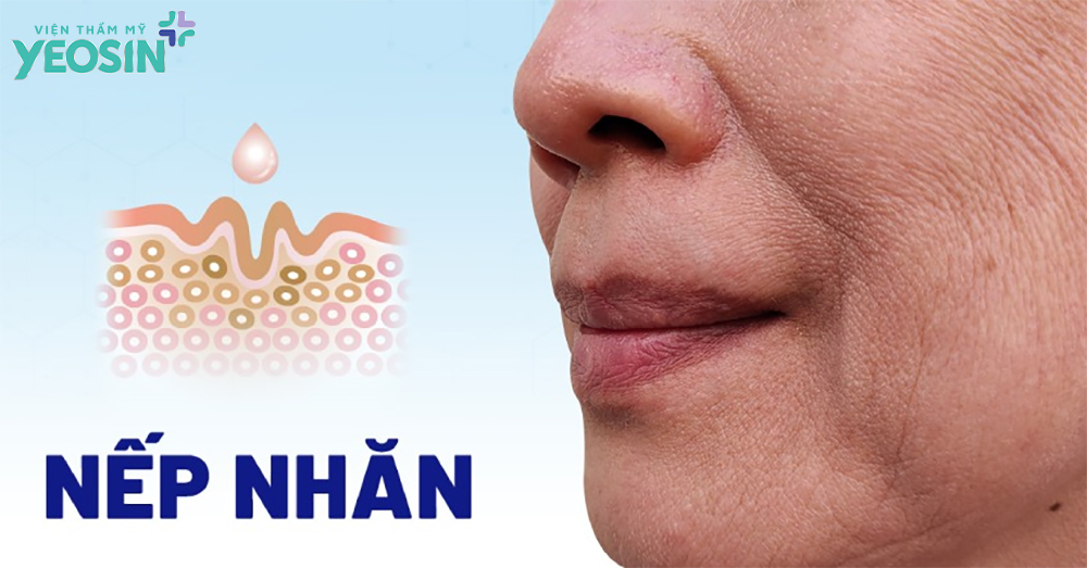 Tiêm xóa nếp nhăn - Phương pháp xóa nhăn hiệu quả 10 Nếp nhăn là gì?