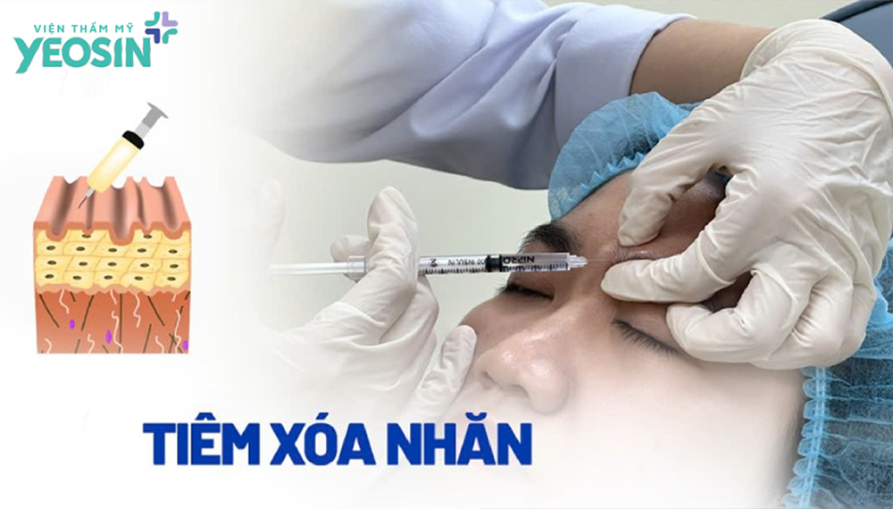 Tiêm xóa nếp nhăn - Phương pháp xóa nhăn hiệu quả 12 Cơ chế hoạt động của phương pháp tiêm xóa nhăn