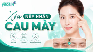 Nếp nhăn giữa 2 chân mày