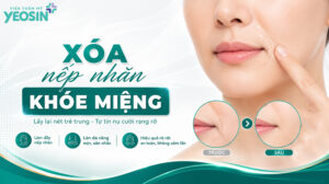 Nếp nhăn khóe miệng