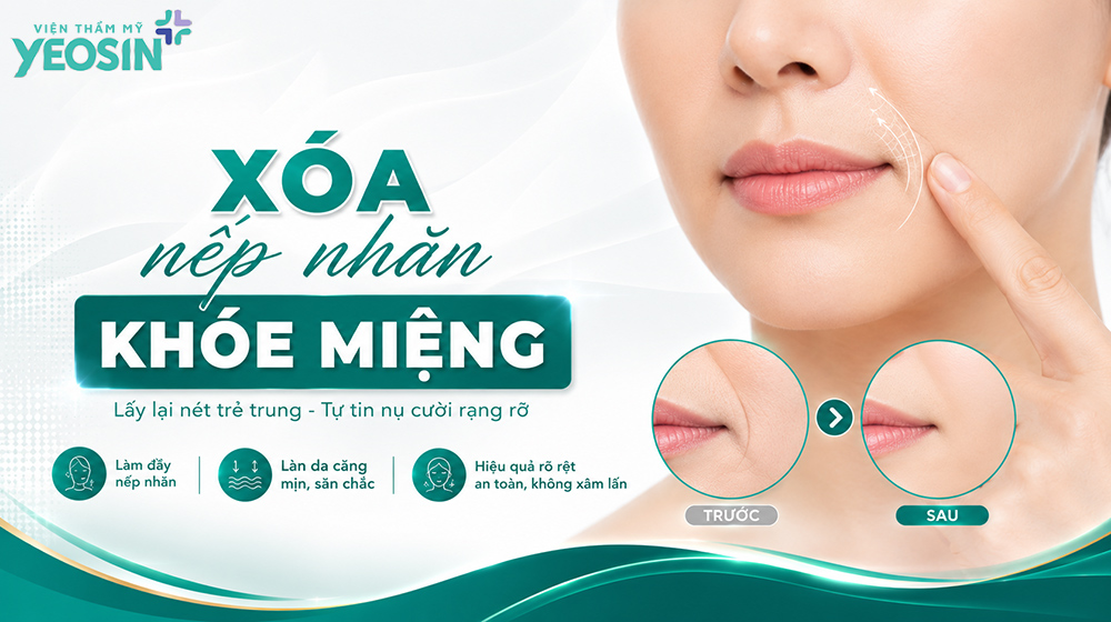 Nếp nhăn khóe miệng