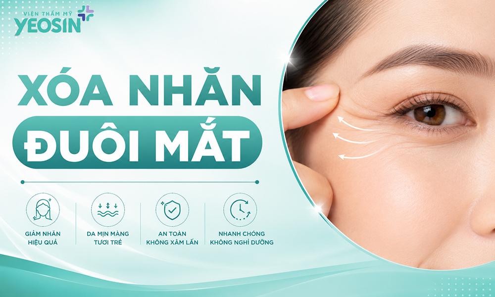 Xóa nhăn đuôi mắt