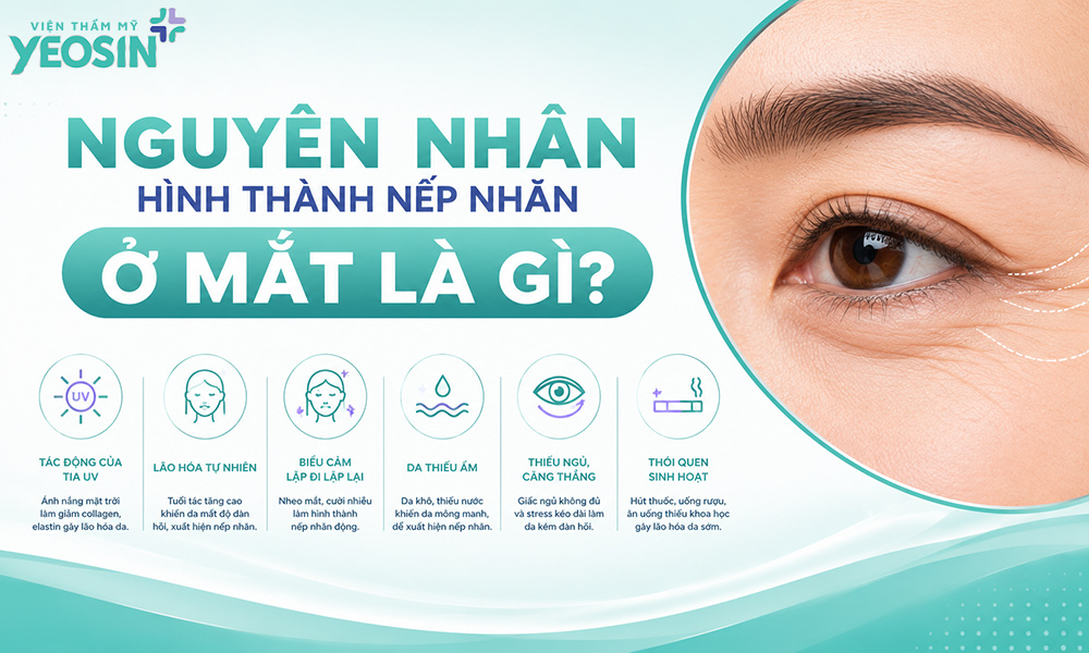 Xóa nhăn đuôi mắt - Xóa nếp nhăn ở mắt hiệu quả 6 Nguyên nhân hình thành nếp nhăn ở mắt là gì?