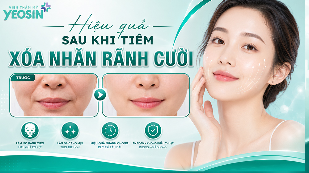 Xóa rãnh cười: Nguyên nhân và cách xóa nếp nhăn rãnh cười 12 Hiệu quả nhận được sau khi tiêm xóa nhăn rãnh cười.