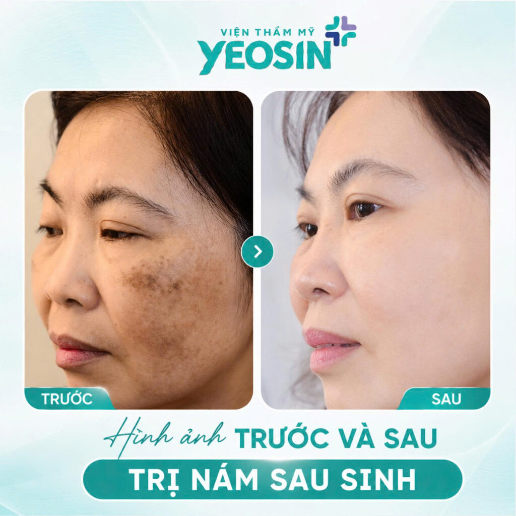 Hình ảnh trước và sau khi trị nám sau sinh tại Yeosin