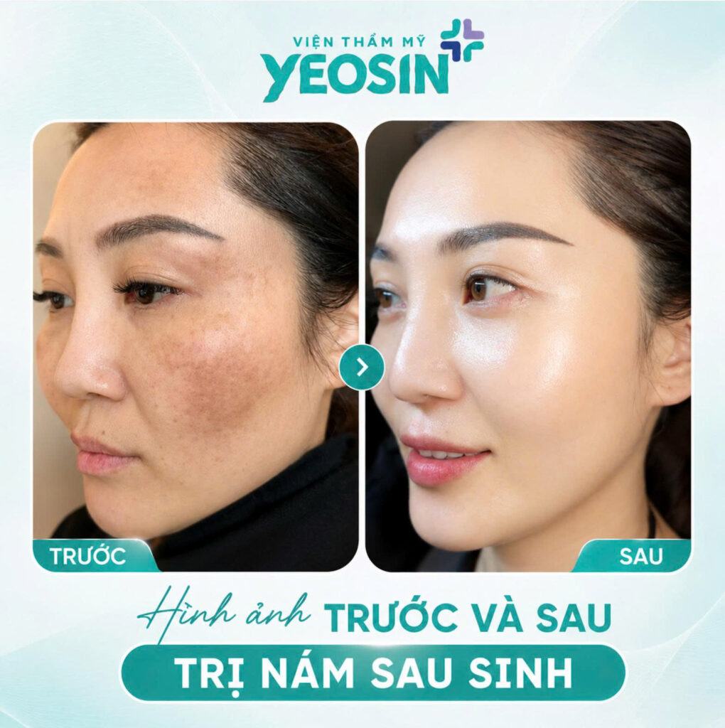 Hình ảnh trước và sau khi trị nám sau sinh tại Yeosin