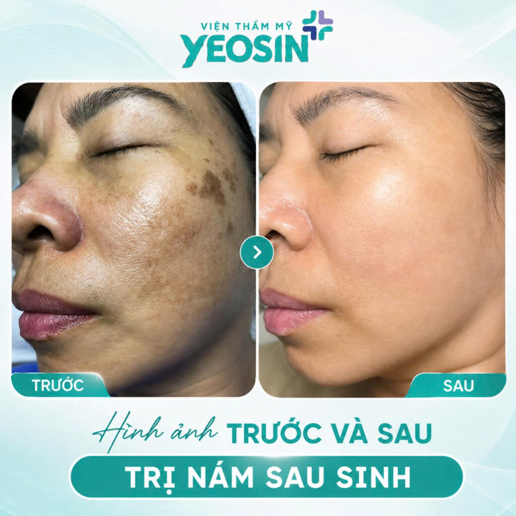 Hình ảnh trước và sau khi trị nám sau sinh tại Yeosin