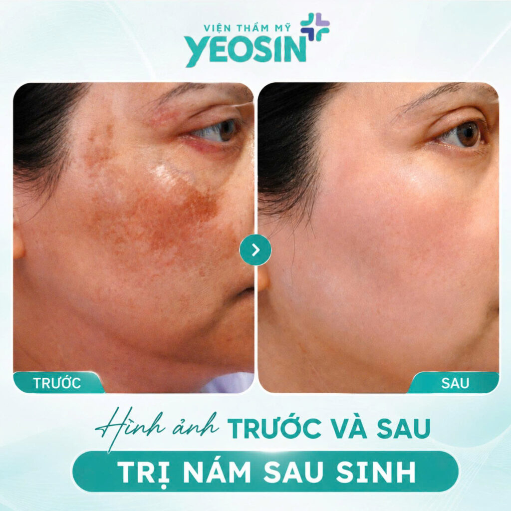 Hình ảnh trước và sau khi trị nám sau sinh tại Yeosin