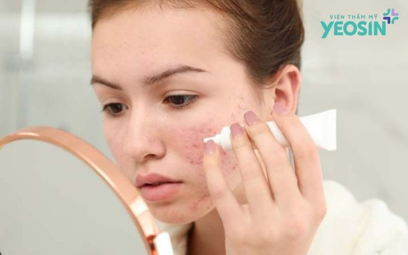 Vì sao thoa kem hay dùng serum không bao giờ hết sẹo rỗ? 6 anh Yeosin 10 1