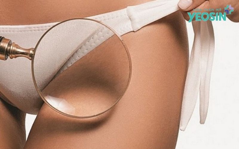 Câu hỏi thường gặp về thâm bẹn