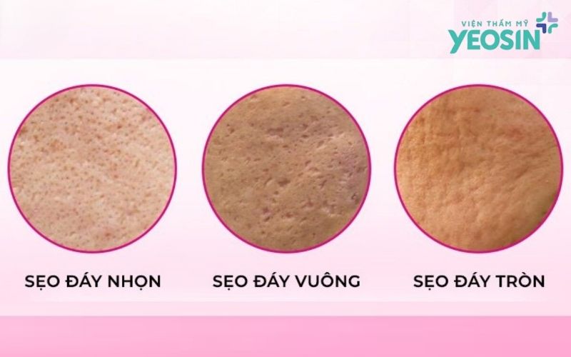 Vì sao thoa kem hay dùng serum không bao giờ hết sẹo rỗ? 7 Phân loại các dạng sẹo rỗ thường gặp