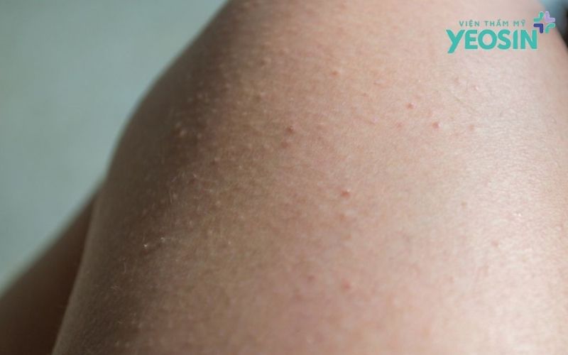 Dấu hiệu nhận biết viêm nang lông