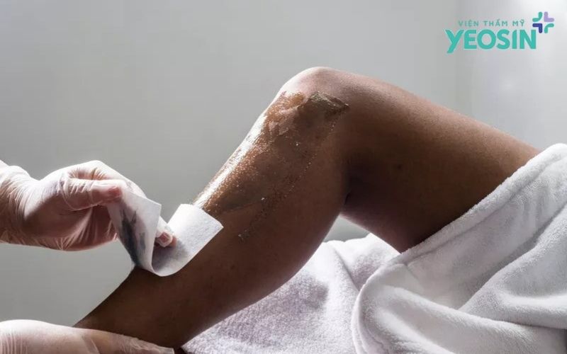 6 sai lầm tai hại khi tự trị viêm nang lông tại nhà