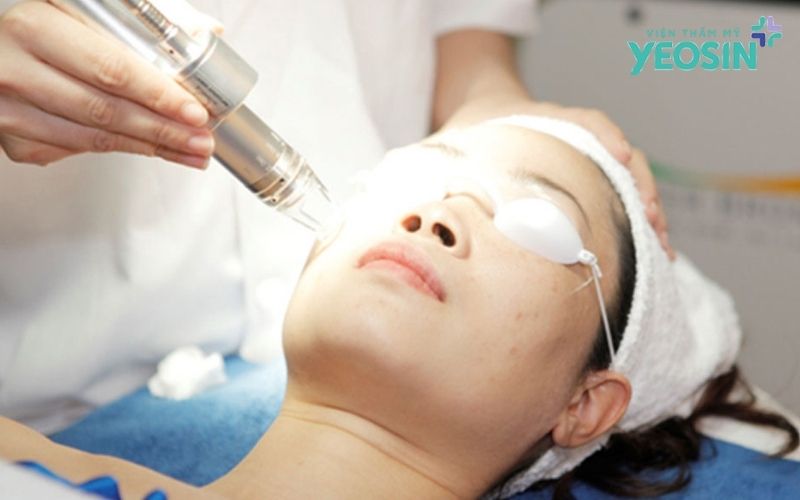 Vì sao thoa kem hay dùng serum không bao giờ hết sẹo rỗ? 9 Công nghệ Filling Scars - Bước tiến tái tạo da tại Yeosin